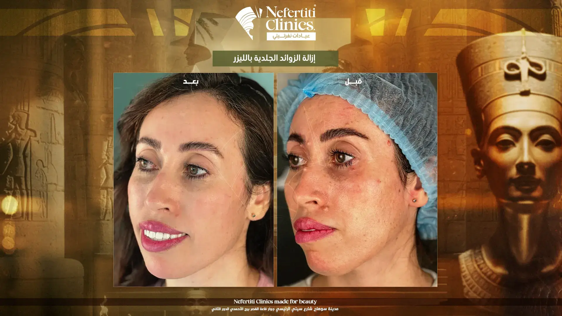 إزالة الزوائد الجلدية بالليزر