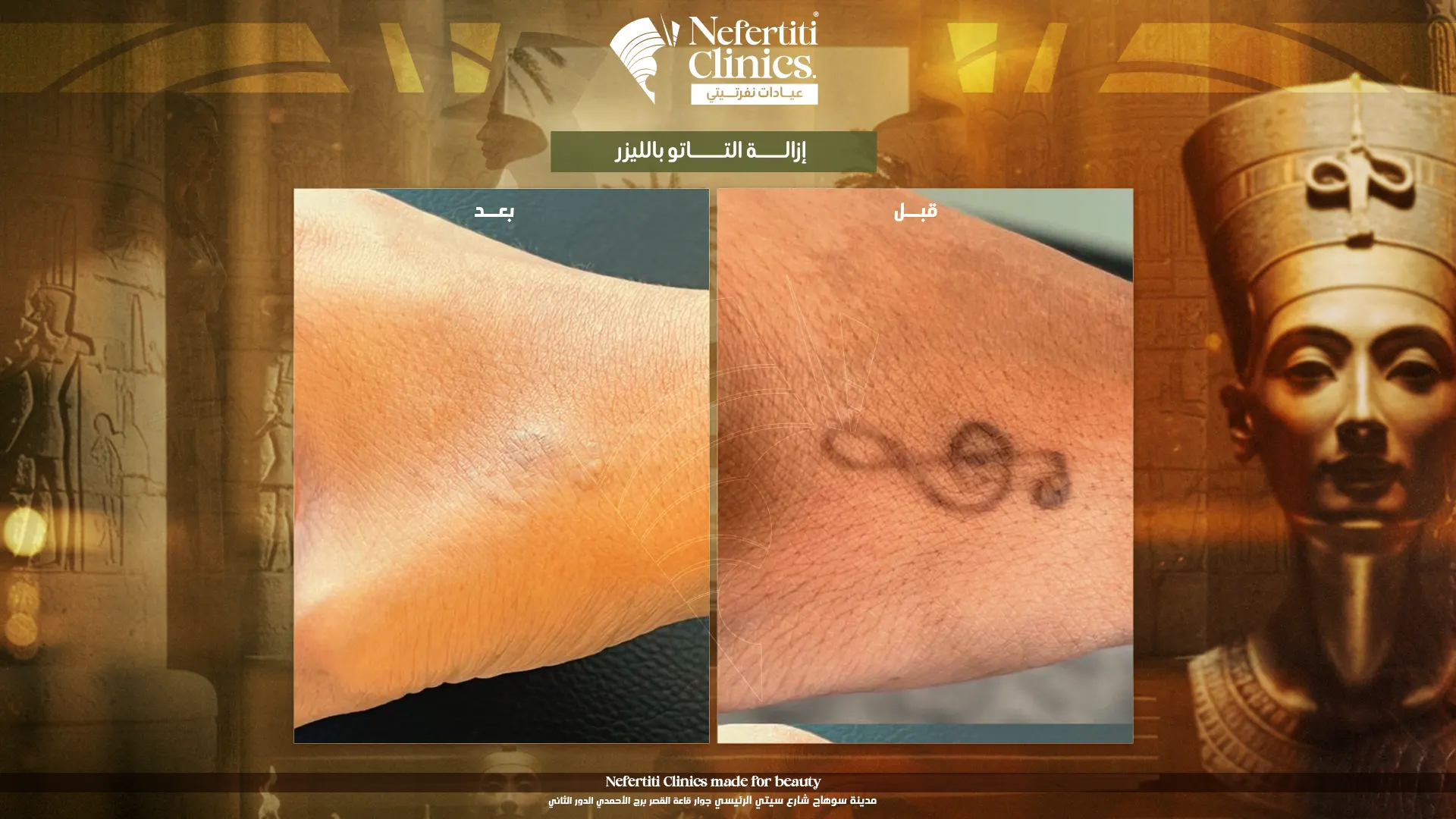 إزالة التاتو بالليزر