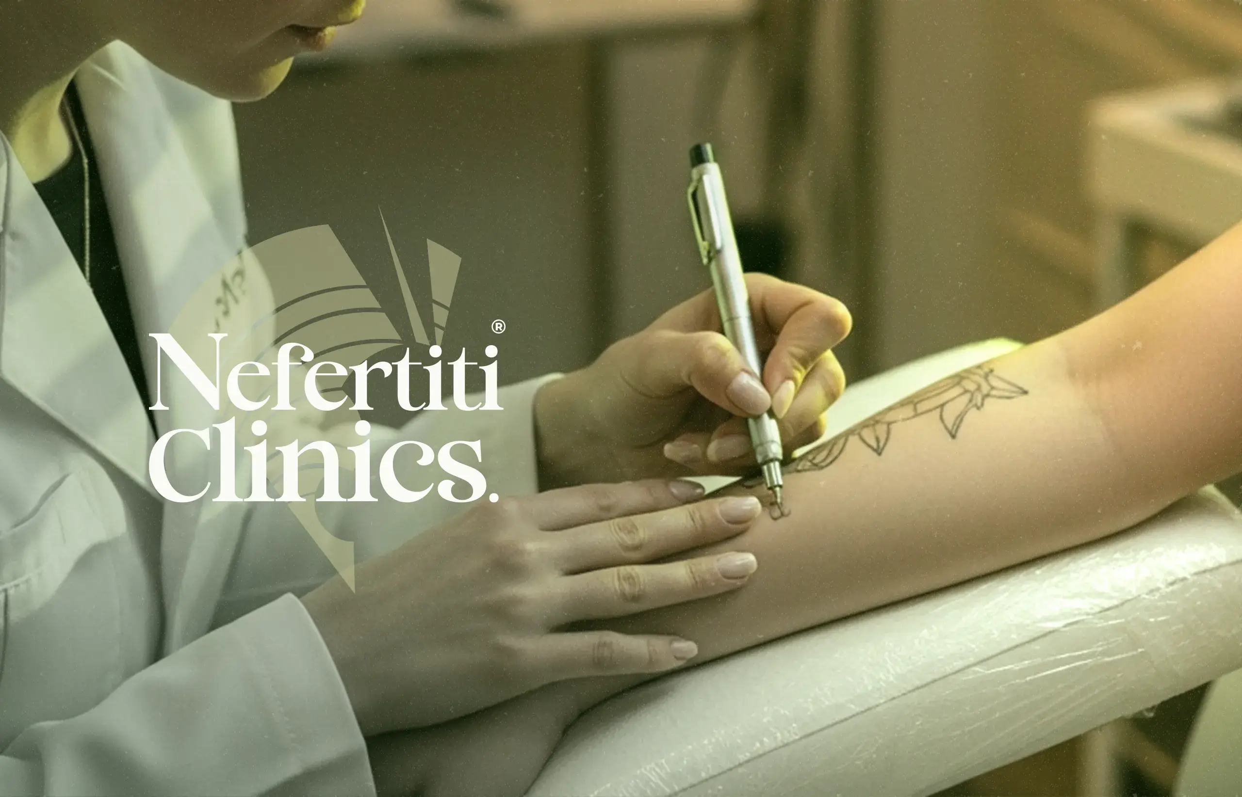 إزالة التاتو بالليزر