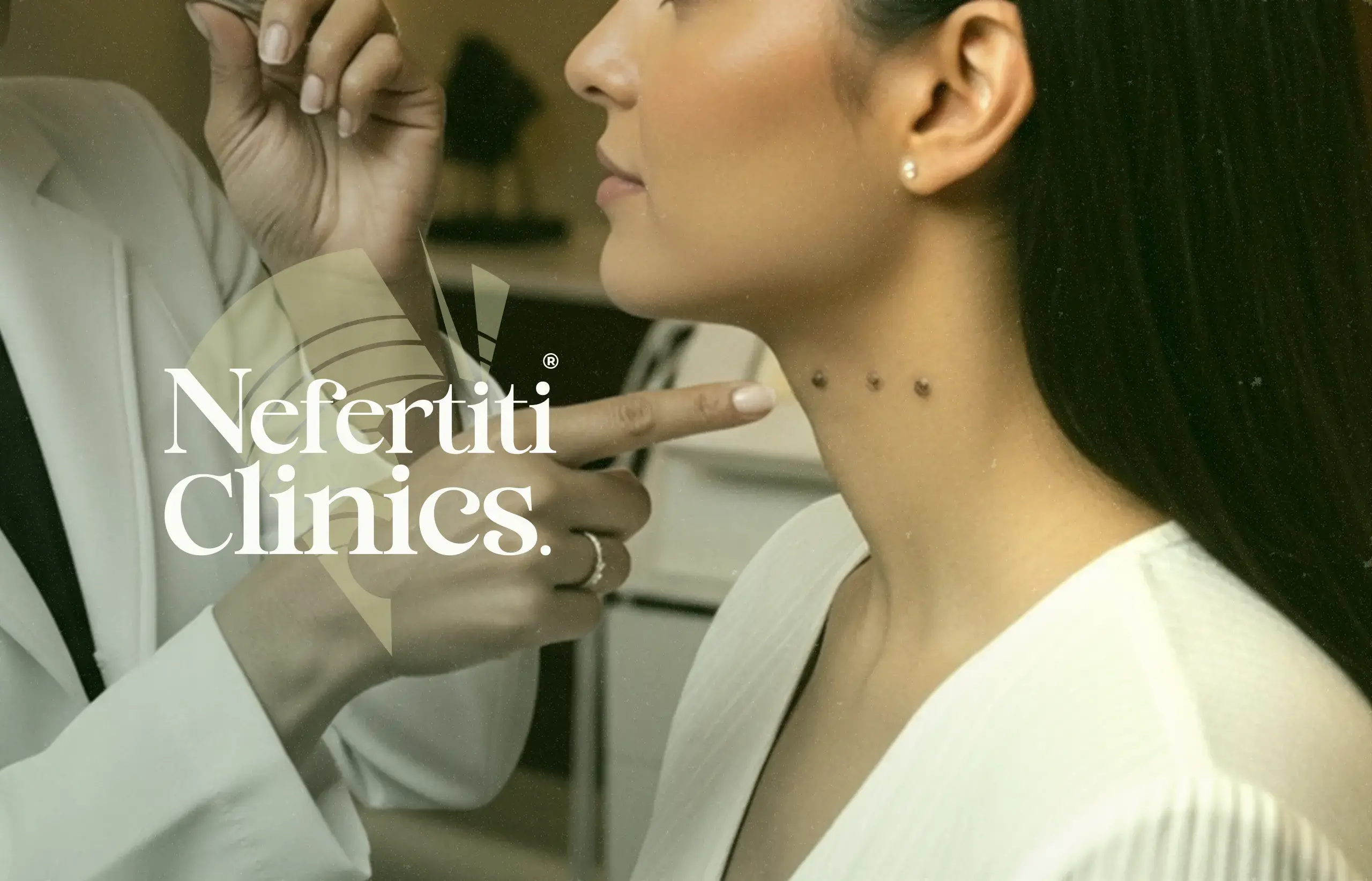 إزالة الزوائد الجلدية بالليزر