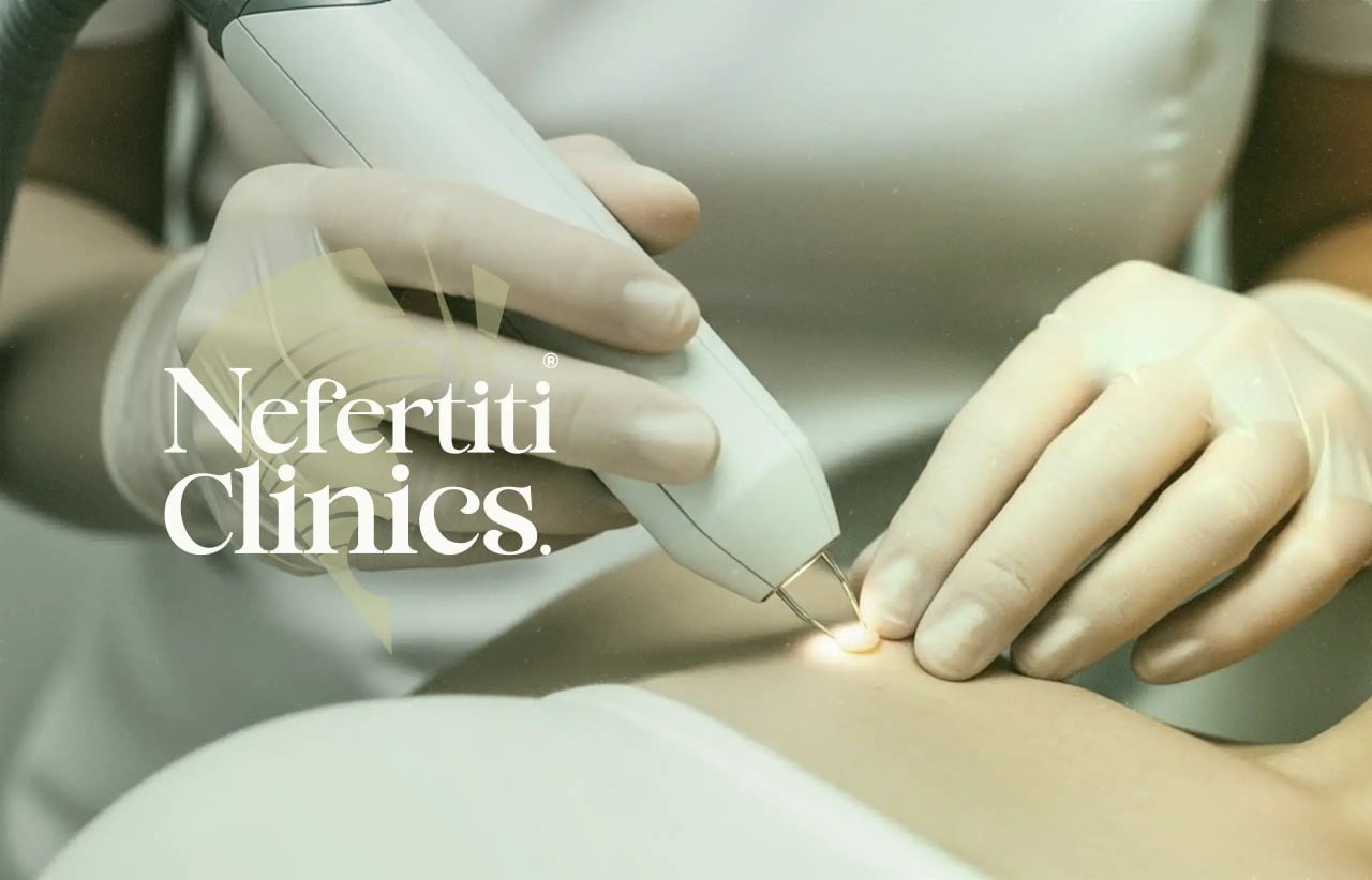 إزالة الشامات والزوائد الجلدية بالليزر في عيادات نفرتيتي