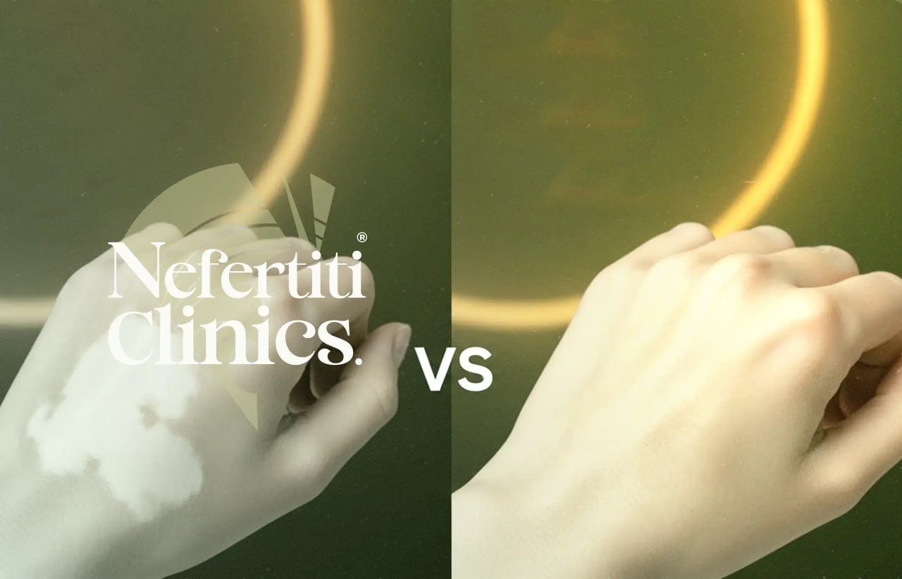 علاج البهاق بالليزر أحدث الطرق في عيادات نفرتيتي 